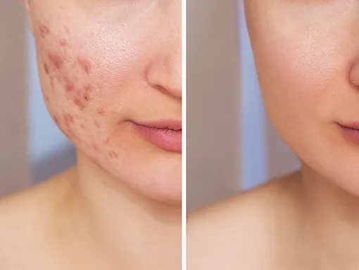 acne reset
